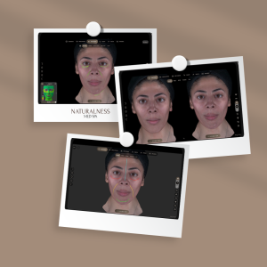 Aura Skin Analysis device capturing detailed skin data at Naturalness Med Spa in Murrieta, CA.