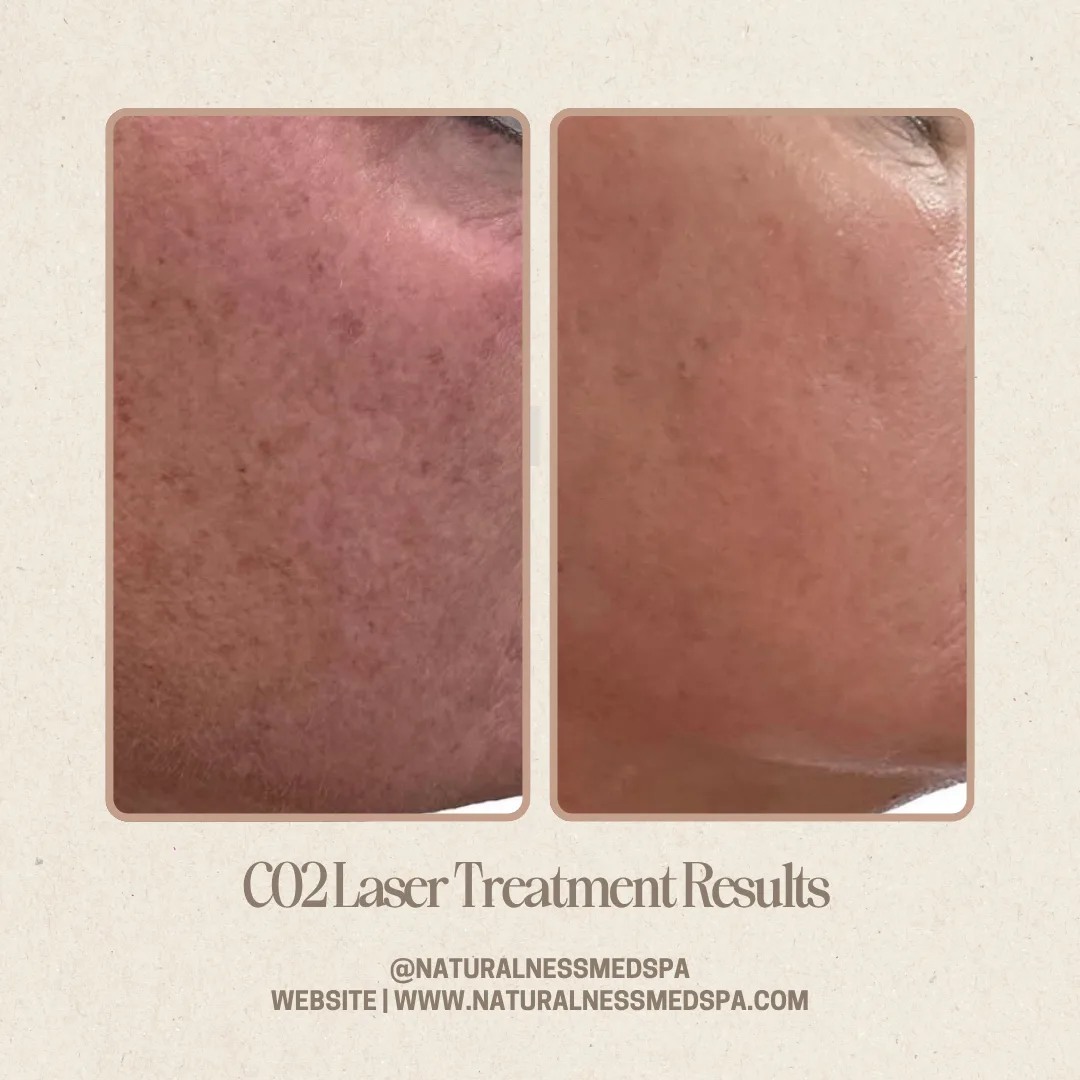 Before and after CO2 laser resurfacing at Naturalness Med Spa in Murrieta, CA