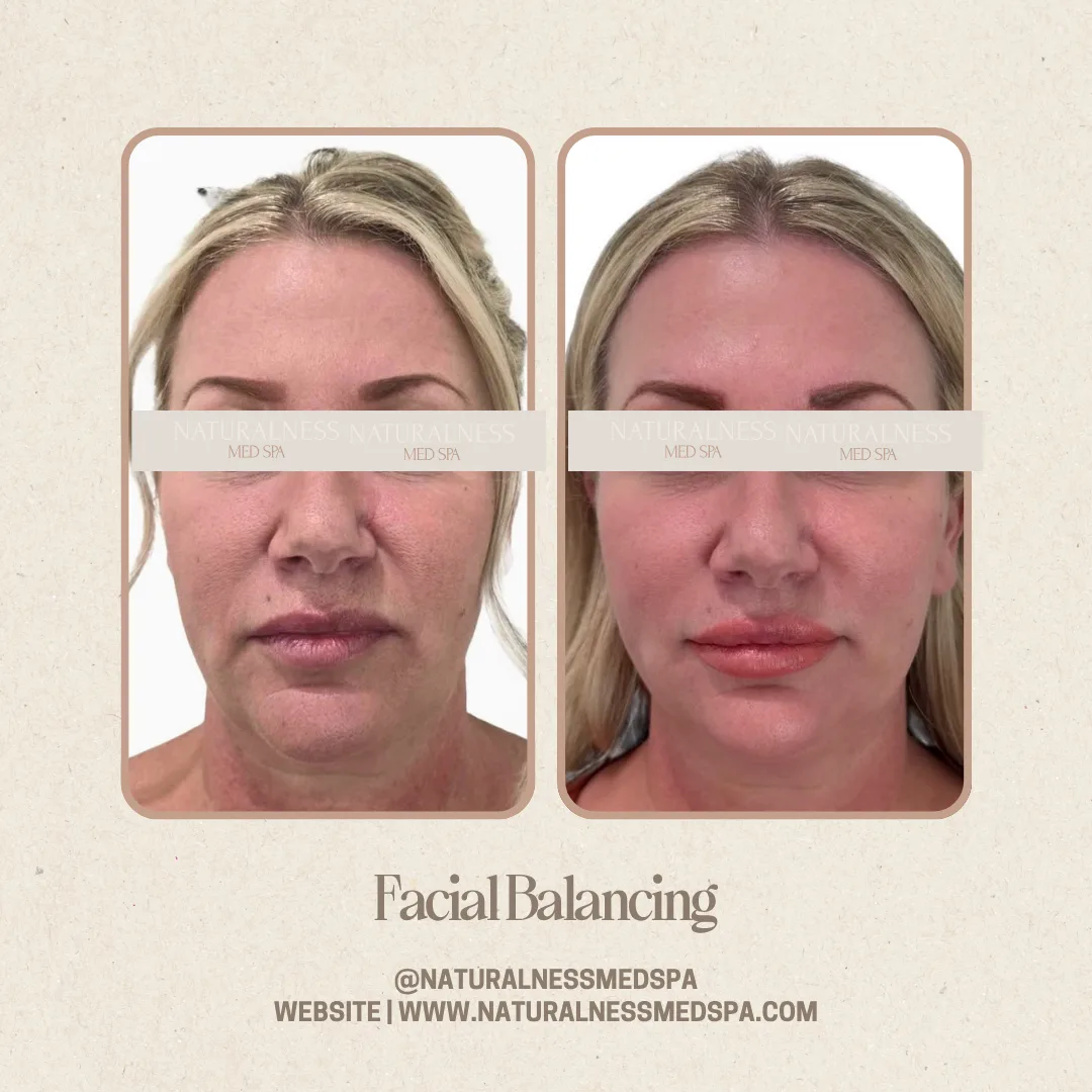 Before and after Facial balancing at Naturalness Med Spa in Murrieta, CA