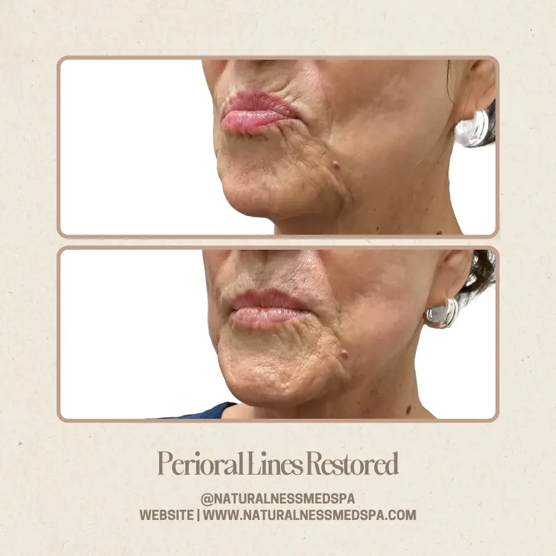 Before and after Perioral lines at Naturalness Med Spa in Murrieta, CA