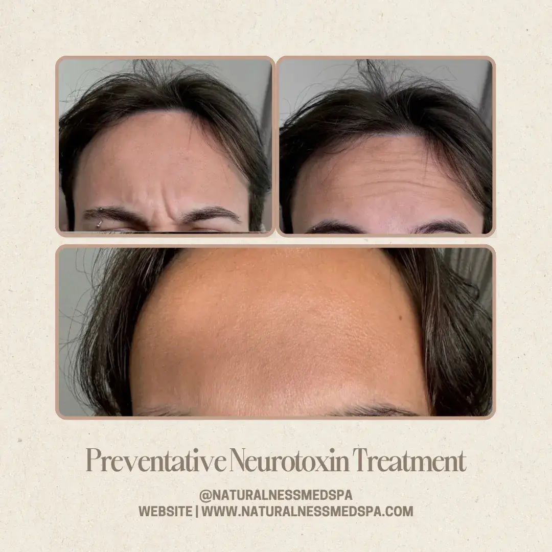 Before and after Preventative neurotoxin at Naturalness Med Spa in Murrieta, CA