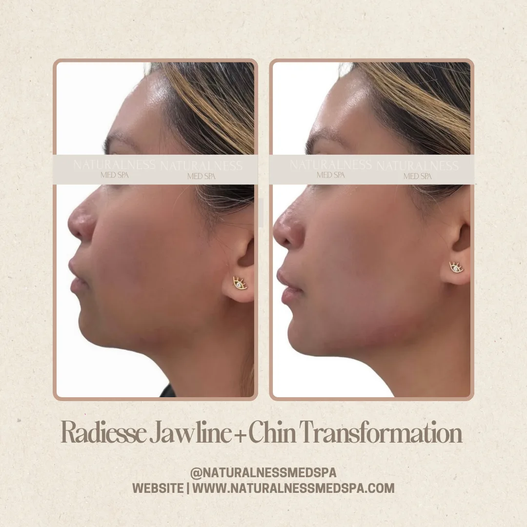 Before and after Radiesse jawline + chin at Naturalness Med Spa in Murrieta, CA