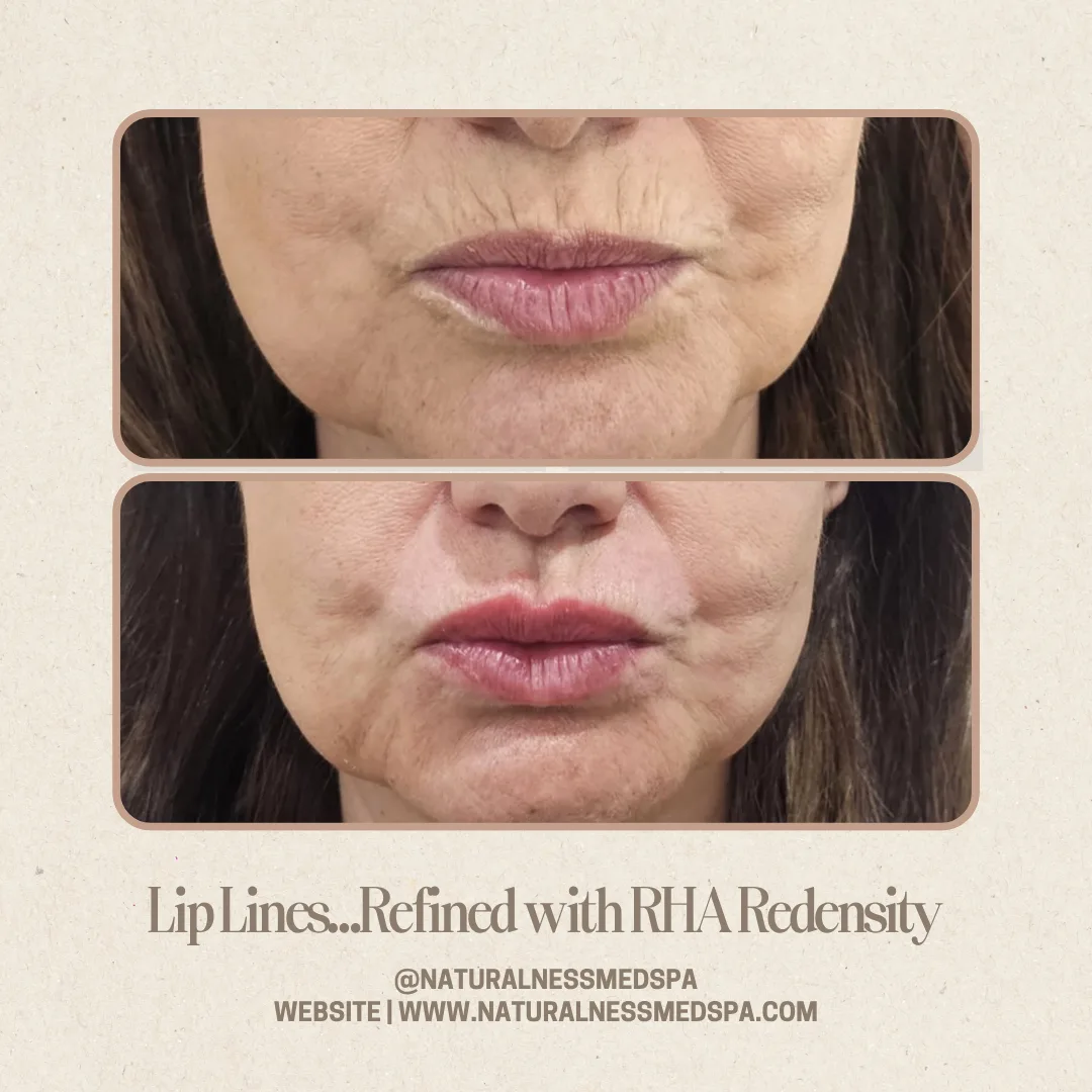 Before and after RHA Redensity for lip lines at Naturalness Med Spa in Murrieta, CA