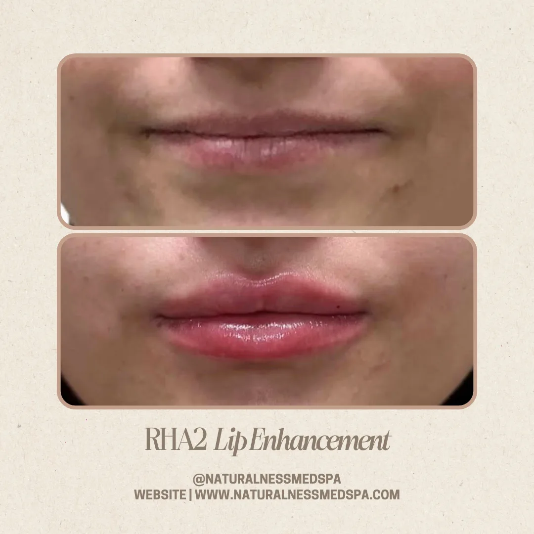 Before and after RHA 2 lip enhancement at Naturalness Med Spa in Murrieta, CA