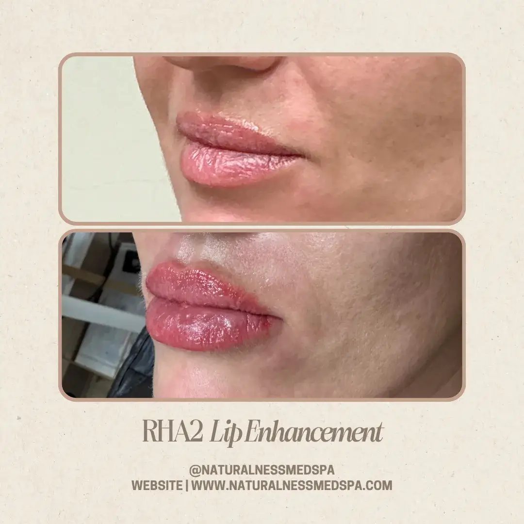 Before and after RHA 2 lip enhancement at Naturalness Med Spa in Murrieta, CA