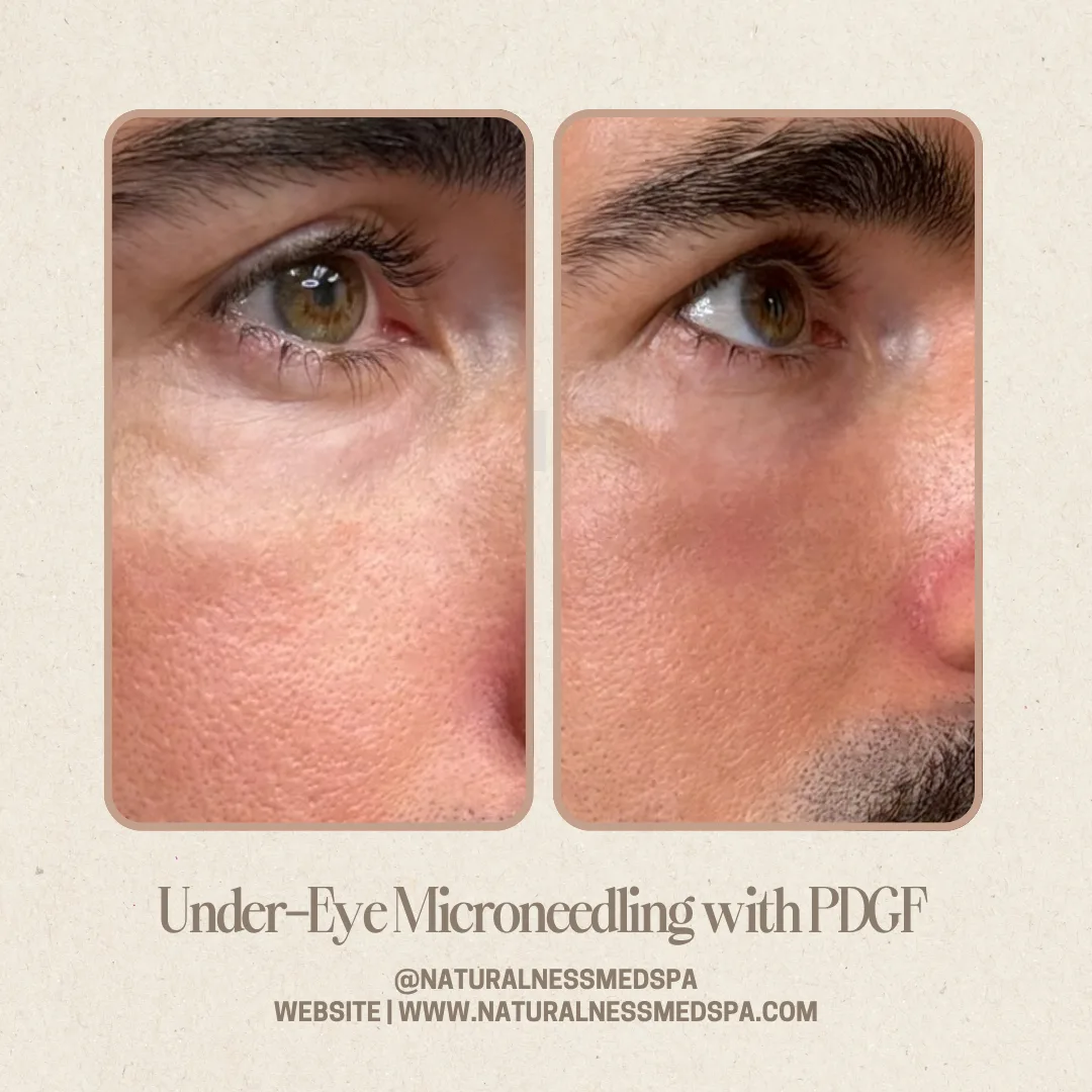 Before and after Under-eye microneedling with PDGF at Naturalness Med Spa in Murrieta, CA